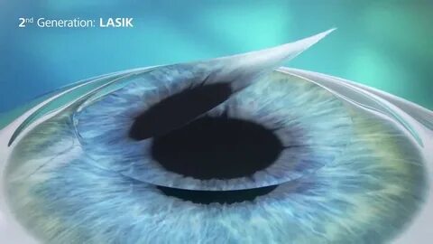 Лазерная коррекция зрения dr smile