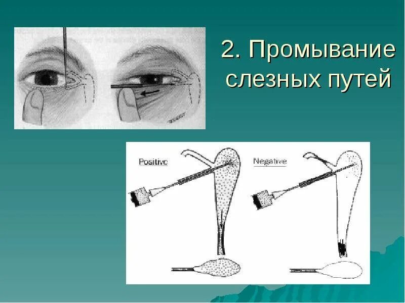 Как прочистить слезные каналы. Инструменты для зондирования слезных путей. Промывание слезных путей. Зондирование слезных путей. Зондирование и промывание слезных путей.