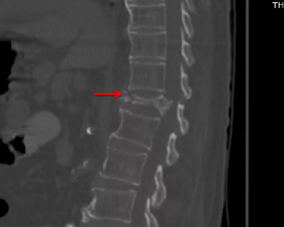 Перелом 12 грудного позвонка рентген. Компрессионный перелом т12 позвонка позвоночника. Компрессионный перелом позвоночника л1. Компрессионный перелом позвоночника т11.