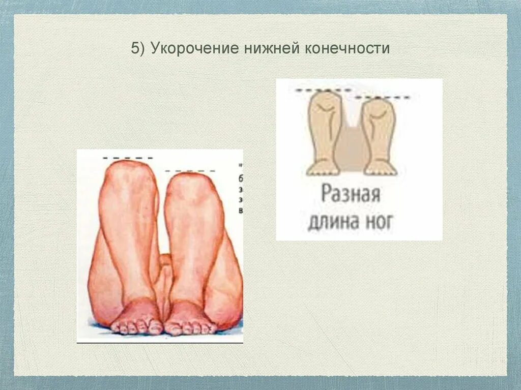 Укорочение ноги у ребенка. Укорочение конечности. Укорочение ноги у ребенка. Укороченные конечности у детей. Укорочение ноги у ребенка.