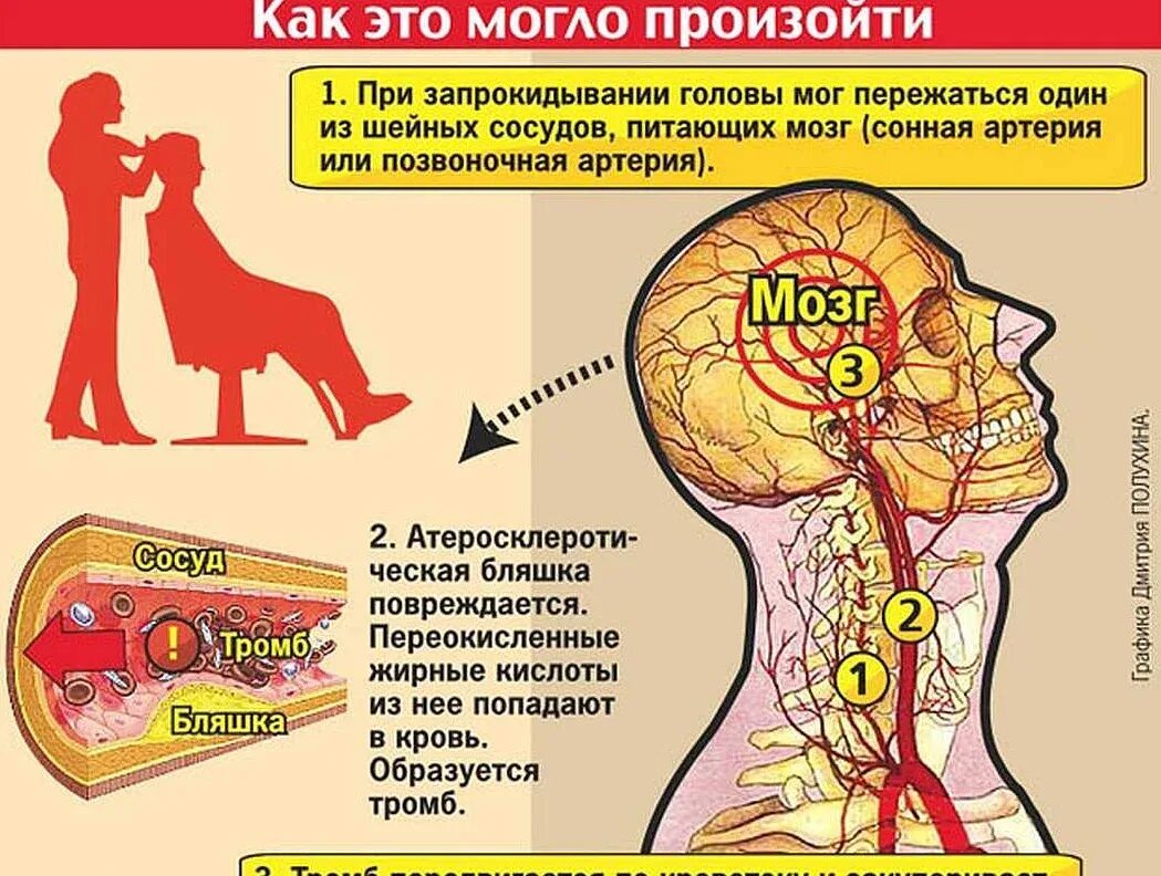 Insult him. Атеросклероз сосудов головного мозга. Сосуды при атеросклерозе. Атеросклероз артерий головного мозга симптомы. Атеросклеротические поражения головного мозга.