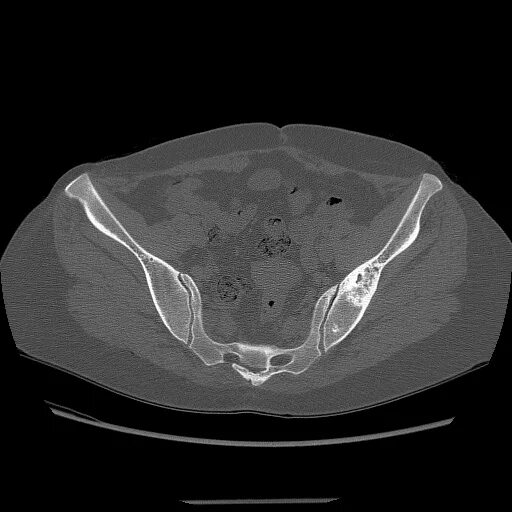 Кт подвздошной кости. Фиброзная дисплазия подвздошной кости на кт. Крыло подвздошной кости кт. Фиброма бедренной кости кт.