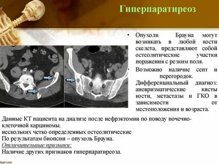 Опухоль низкой активности