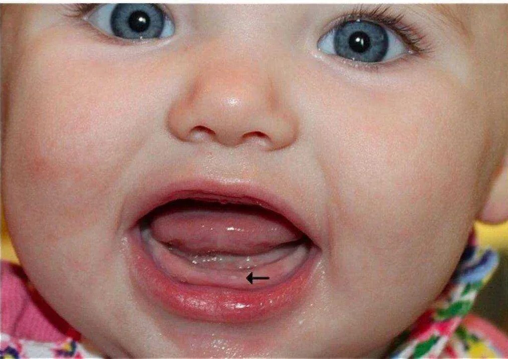 Ребенку 5 лет лезет зуб. Десна при прорезывании зубов у грудничков. Десна у грудничка при прорезывании. Десна при прорезывании зуба. Ппрпкщывание зубов у детей.
