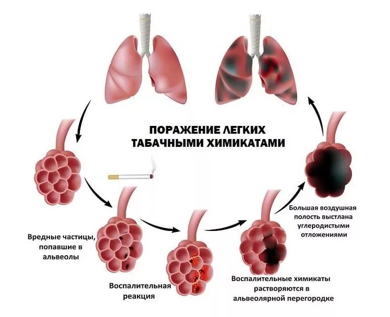 Боль тяжесть в легких