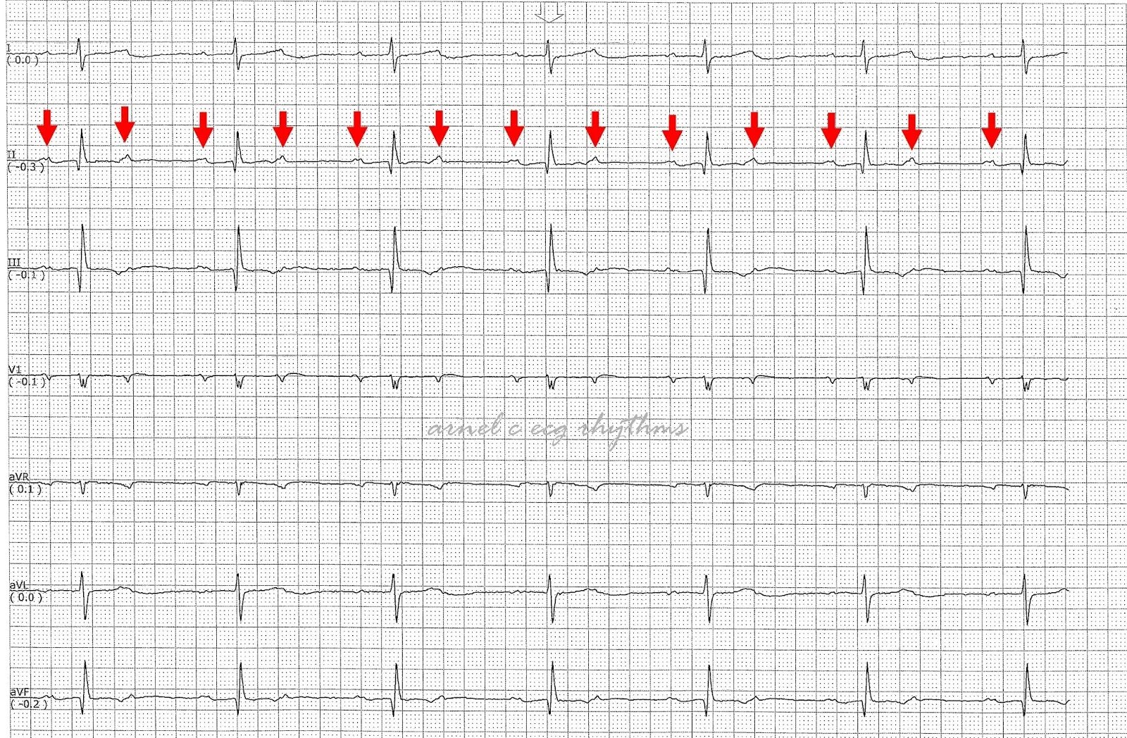 Av Block ECG. ECG av Block 3. EKG complete av Block. ECG complete av Block.