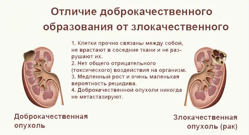 Образования в почке у мужчин. Доброкачественные и злокачественные опухоли почек. Паренхима почки новообразование это. Доброкачественная опухоль почки. Опухоли паренхимы почек.