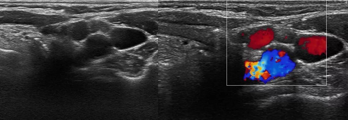 Щитовидная железа узи лимфоузлы. Аксиллярные лимфоузлы УЗИ. УЗИ лимфатических узлов шеи. Подчелюстные лимфоузлы на УЗИ. Лимфоузлы щитовидной железы на УЗИ.