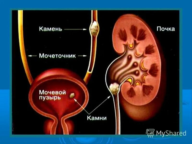 расположение камней в почках. выход камня из мочеточника у мужчин. мочекаменная болезнь камень в мочеточнике. камни в почках мочеточнике и мочевом пузыре. заболевания мочевыделительной системы мочекаменная болезнь.
