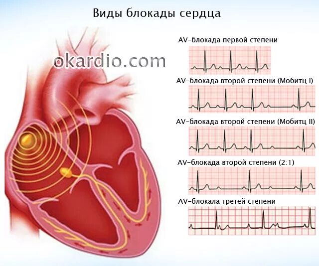 Блокада проводящей системы сердца ЭКГ. Блокада 1 степени сердца на ЭКГ. Блокада сердца 2 степени ЭКГ. Блокады сердца как определить.