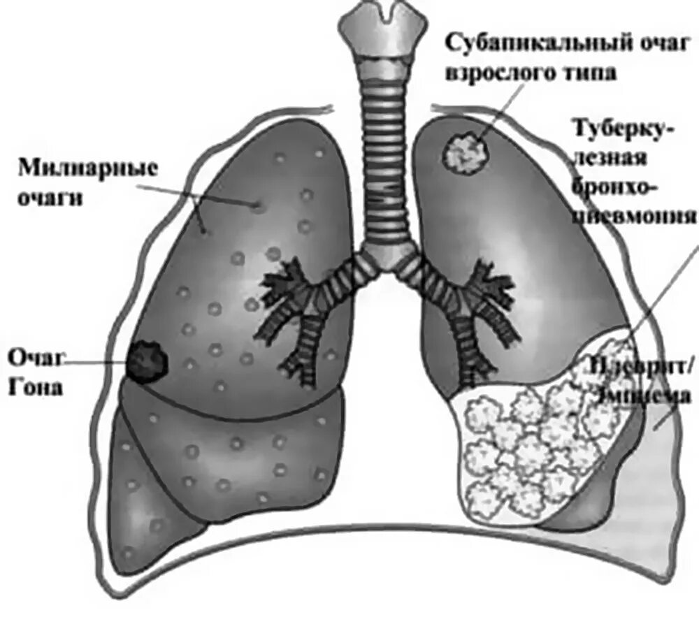 Легкие человека с туберкулезом