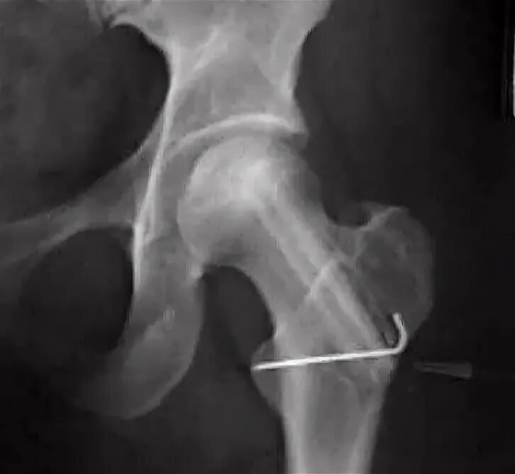 ТБС рентген асептический некроз. Асептический некроз тазобедренного кости. Исход асептического некроза головки тазобедренного сустава. Некроз головки бедренной кости рентген.
