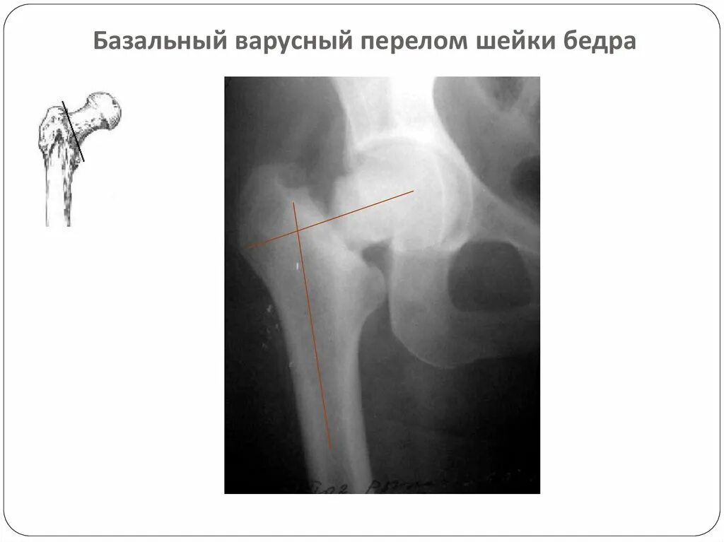 Шейки левого бедра. Перелом бедренной кости рентген. Вколоченный перелом шейки бедра рентген. Субкапитальный перелом шейки бедренной кости рентген. Закрытый аддукционный перелом шейки бедра.