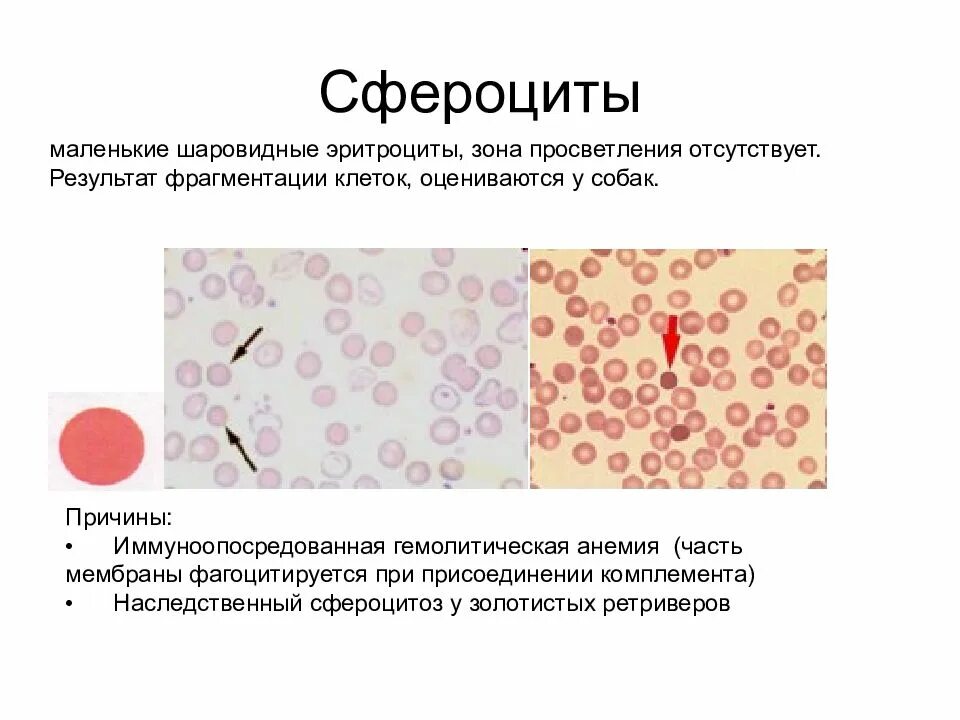 Патологические формы эритроцитов. Сфероциты. сферическая форма эритроцитов. сфероциты эритроциты. шаровидные эритроциты.