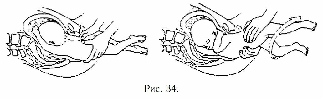 Тазовое предлежание плода кесарево. Кесарево сечение извлечение плода. Кесарево сечение при тазовом предлежании. Техника извлечения плода при кесаревом сечении. Ножное предлежание плода роды.