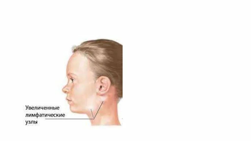 Лимфоузлы синдром. Тонзиллярный лимфоузел. Увеличенные лимфатические узлы. Лимфопролиферативный синдром.