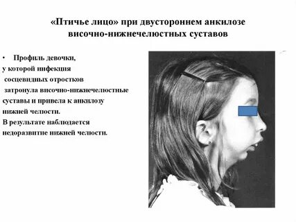 Недоразвитие челюсти