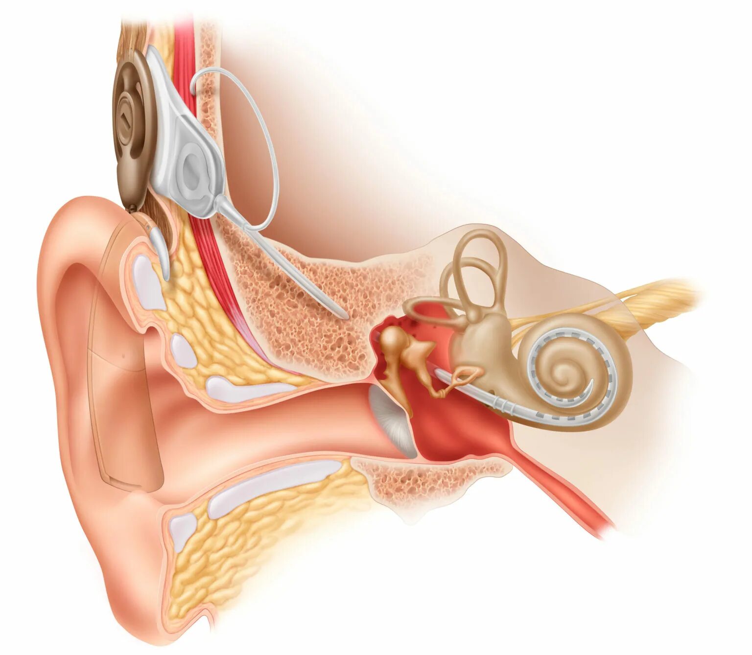 Отосклероз уха операция. Кохлеарный отосклероз операция. Кохлеарный имплант кохлеар. Отосклероз операция или слуховой аппарат. Слуховой аппарат операция.