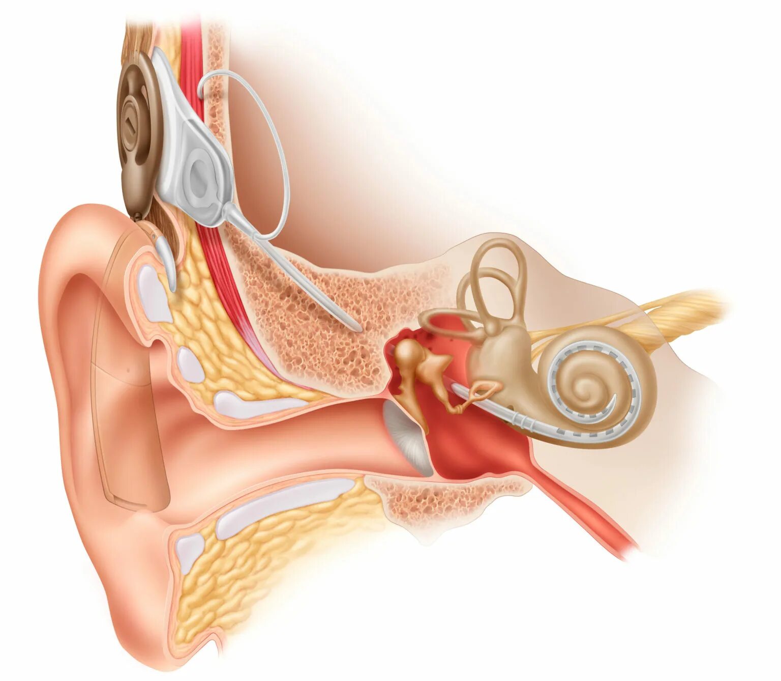 Кохлеарный отосклероз операция. Кохлеарный имплант кохлеар. Отосклероз операция или слуховой аппарат. Слуховой аппарат операция. Отосклероз уха операция