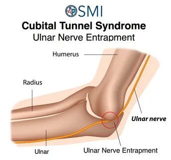 Cubital-Tunnel-Syndrome-Ulnar-Nerve-Entrapment-OSMI-hand-Therapy-center - The Or