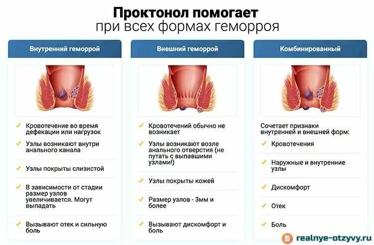 Геморрой причина появления у мужчин лечение. Внешний наружный геморрой. Внешние проявления геморроя.