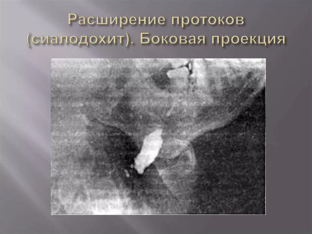 Сиалодохит. Паренхиматозный сиаладенит. хронический паренхиматозный сиалоаденит рентген. хронический сиалодохит. сиалодохит рентгенодиагностика.