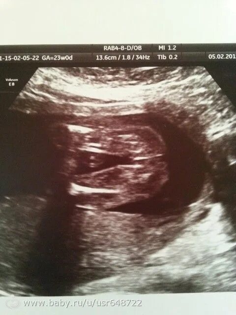 может ли узи ошибиться с полом ребенка на 20 неделе. узи 12 недель беременности в профиль. узи 20 недель беременности ошибается ли. пол ребёнка на узи 20 недель. узи 20 недель беременности ошибается ли.