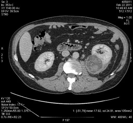 Гипернефроидный с-r на кт. Рак почки метастазы печени. Метастазирование опухоли почки. Рак почки метастазы печени. Метастазы опухоли почки.