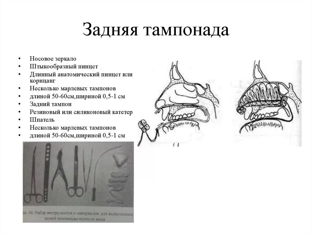 Передняя тампонада при носовом кровотечении. Задняя тампонада носа алгоритм. Задняя тампонада полости носа алгоритм. Тампонада полости носа алгоритм. Задняя тампонада носа оснащение.