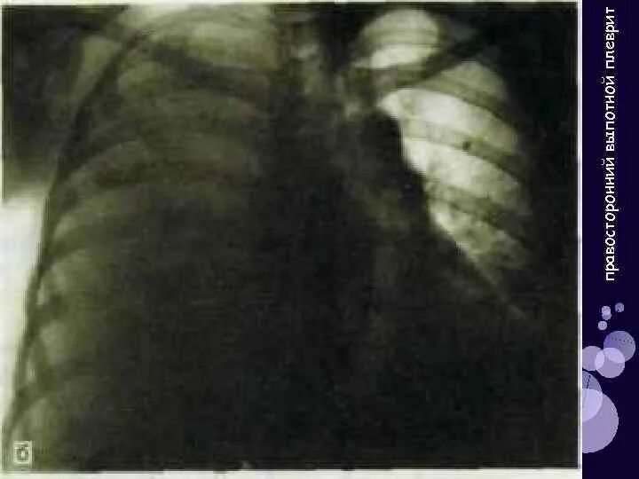 Поражен легких 3. Тотальоне затемнеие половниу грудной клетки. Синдром обширного затемнения легочного поля. Синдром обширного затемнения легочного поля рентген. Тотальное затемнение легочного поля слева.