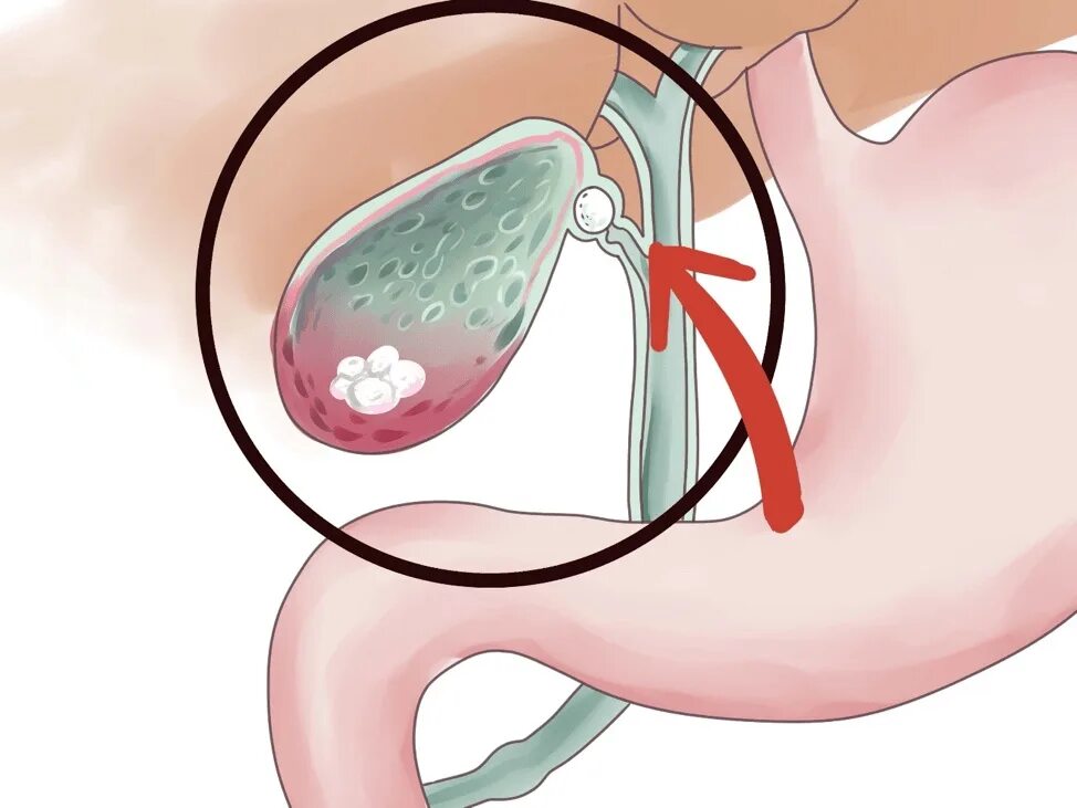 Удален желчный пузырь симптомы. Камень в протоке желчного пузыря. Полипоз желчного пузыря. Камни в желчевыводящих протоках.