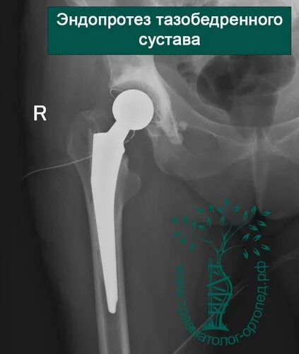 Замена т б сустава. Тотальное гибридное эндопротезирование тазобедренного сустава. ТЭТС тазобедренного сустава. Компоненты тотального эндопротеза тазобедренного сустава. Эндопротезирование тазобедренного сустава в травматологии.