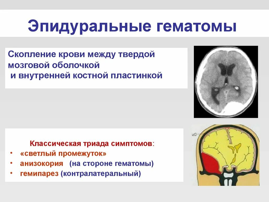 Симптомы эпидуральной гематомы неврология. Эпидуральная гематома ЦСЖ. Эпидуральная и субдуральная гематома отличия. Источники формирования эпидуральной гематомы. Гематома черепно мозговой травме