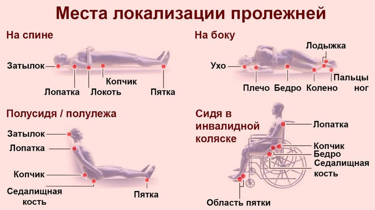 Сколько дней должен лежать. Пролежни клинические рекомендации 2020. Внешние факторы образования пролежней. Места локализации пролежней. Места возникновения пролежней таблица.