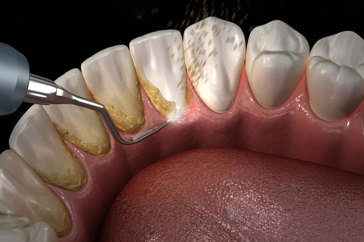 Чистка зубов в нижнем. Зубной камень наддесневые отложения. Поддесневой зубной камень. Дуб и камень.
