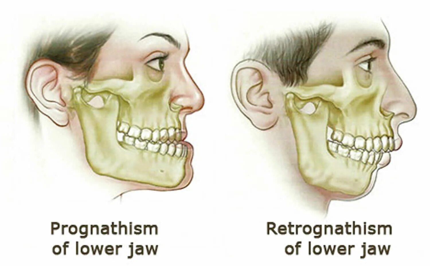 Jaw me