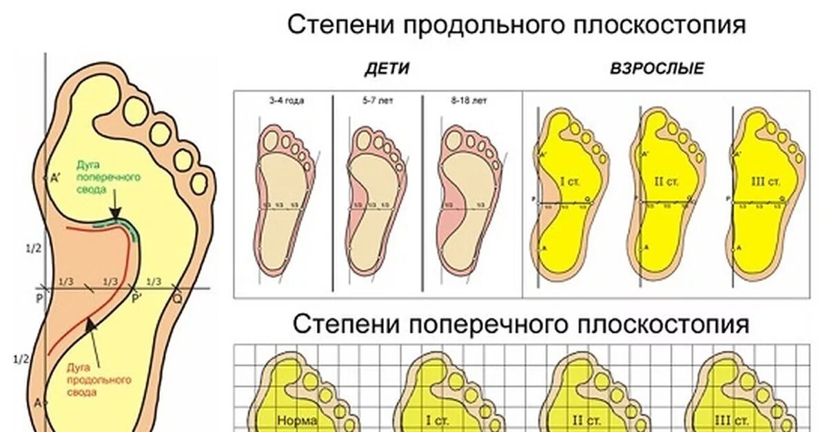 Поперечное 1 степени. Продольное плоскостопие стоп 2 степени. Продольное и поперечное плоскостопие 1 2 3 степени. Плоскостопие поперечного свода стопы. Плоскостопие 4 степени армия.