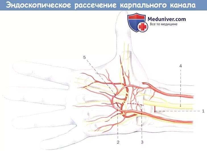 Операция карпального канала кисти. Синдром запястного (карпального) канала. Анатомия срединного нерва в карпальном канале. Анатомия срединный нерв канал карпальный. Синдром карпального клапана кисти.