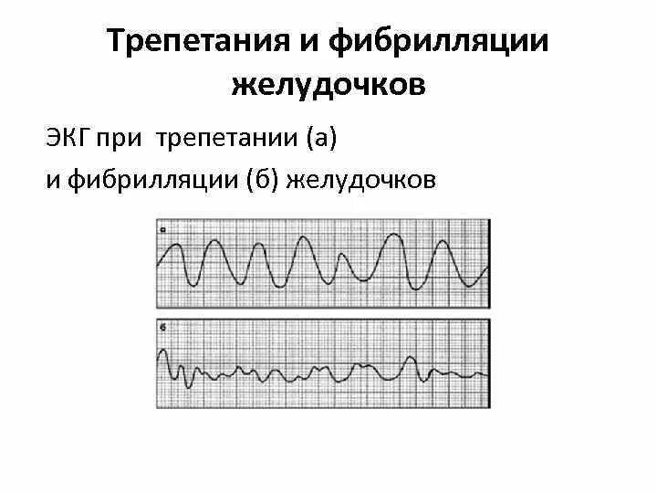Мелковолновая фибрилляция желудочков экг. Фибрилляция желудочков экг критерии. Фибрилляция желудочков экг выражение. Фибрилляция желудочков экг. Фибрилляция желудочков экг.