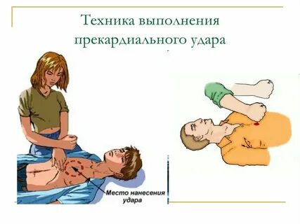 Нанесение прекардиального удара в область грудины