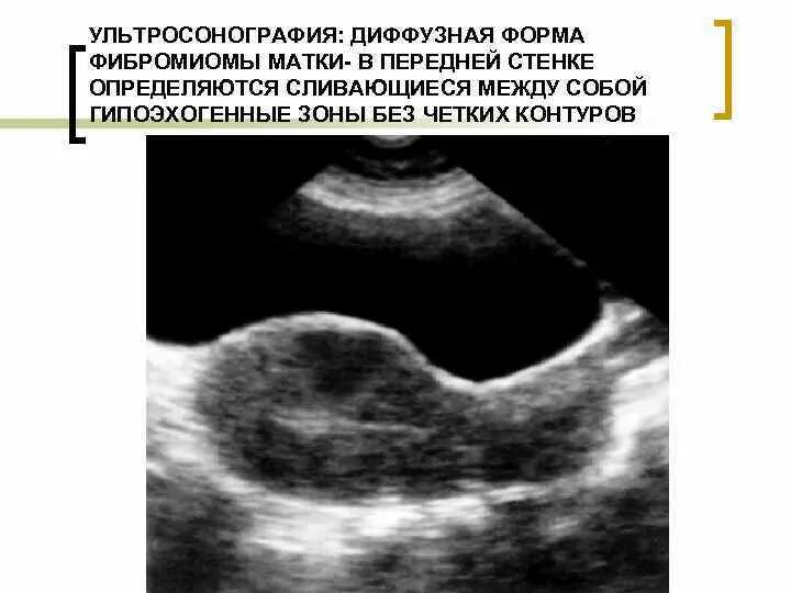 Миома матки на ранних сроках. Передняя и задняя стенка матки на УЗИ. Гипоэхогенные зоны в матке. Узел миомы по передней стенке.