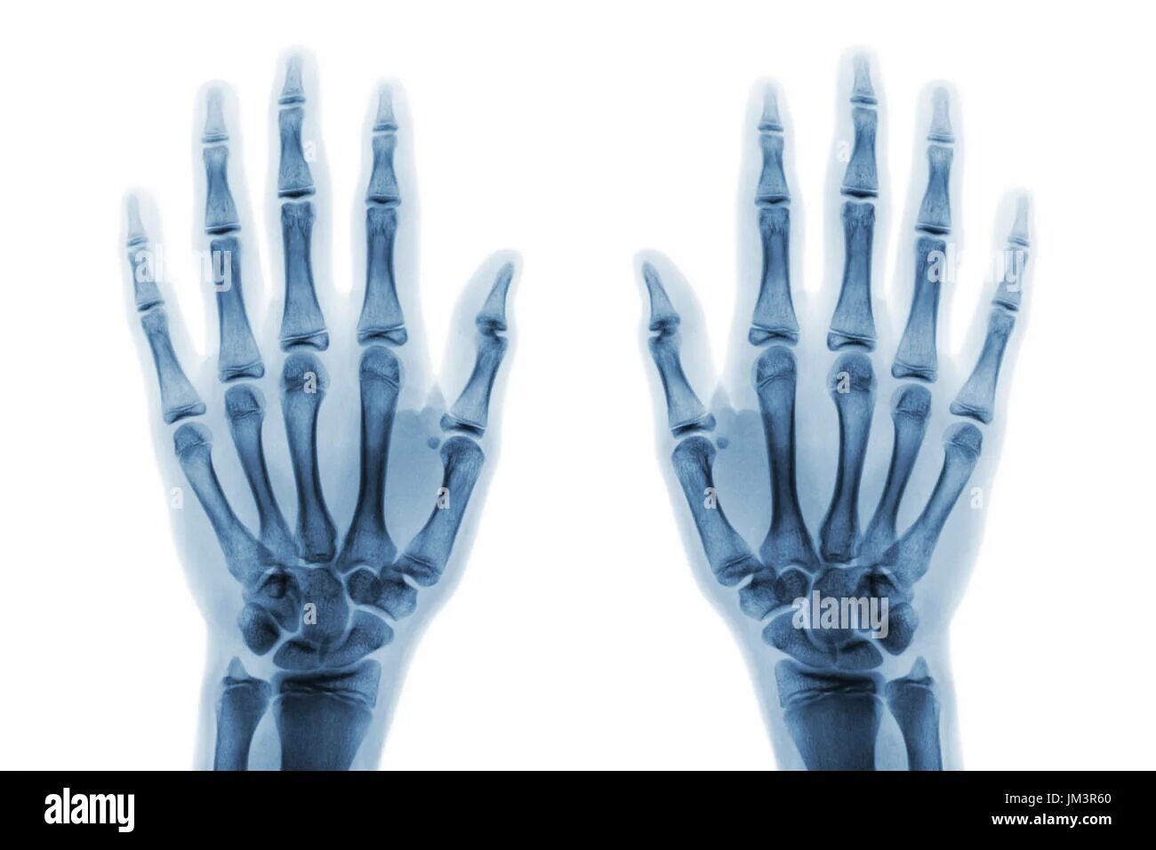 Рентген лучезапястного сустава кошки. Normal hand XRAY. Рентген руки с переломомопухшая рука. Main ap