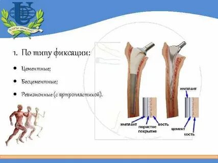 Типы фиксаций