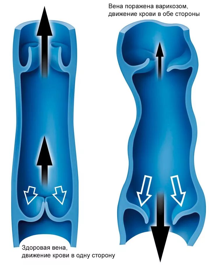 Варикозное расширение вен клапаны. Функция венозных клапанов. Вены ног клапаны