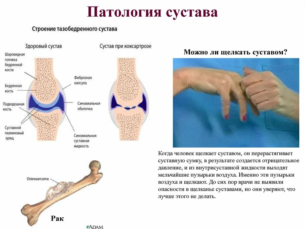 Патологический сустав.