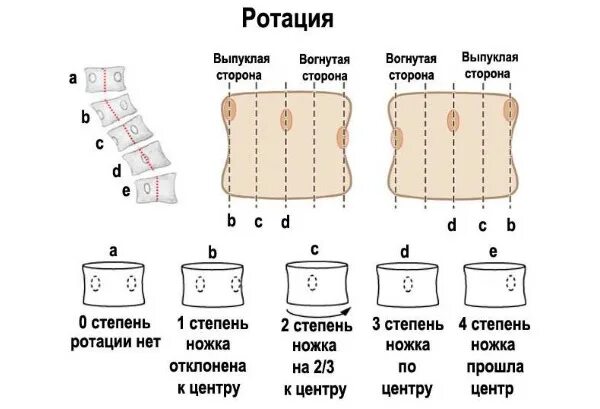 Ротации 2025. Ротация позвонков степени. степени ротации тел позвонков рентген. как определить ротацию тел позвонков. степени ротации позвонков рентген.