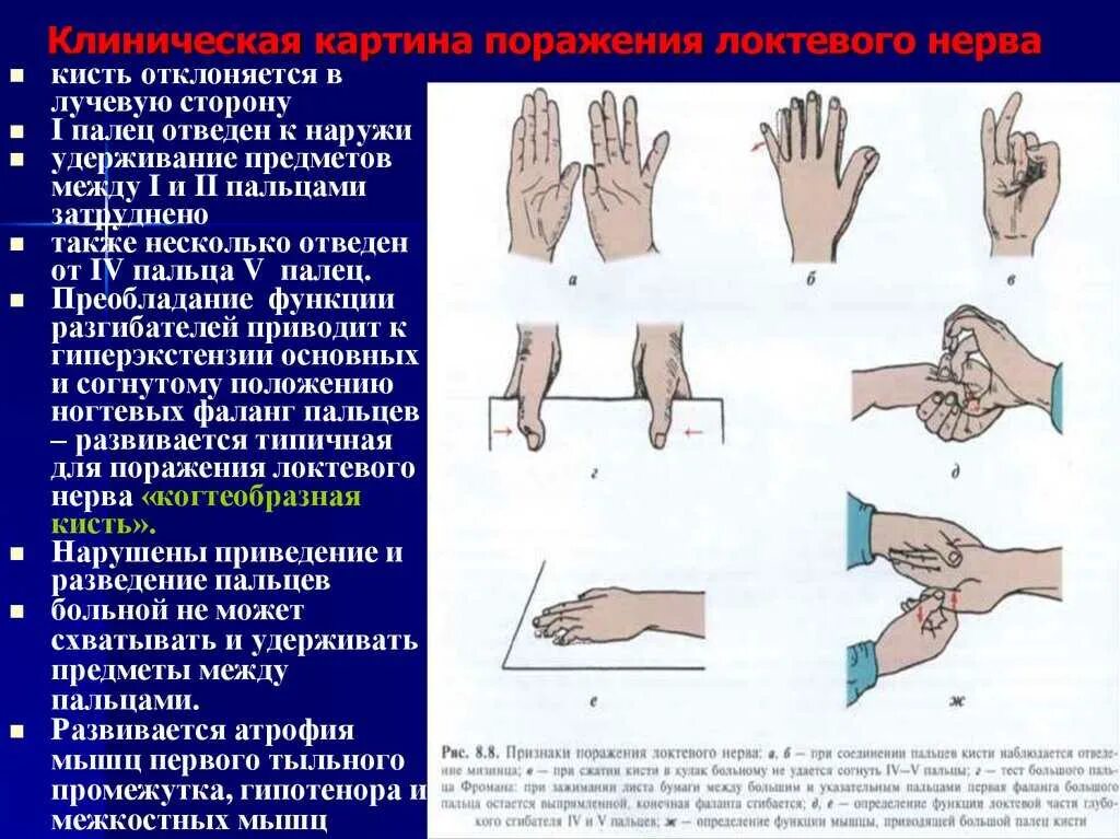 Невропатия нерва руки. Лучевой и локтевой нерв. Симптомы поражения. Синдром поражения локтевого нерва. Нейропатия локтевого нерва клиника. Невропатия локтевого нерва симптомы.