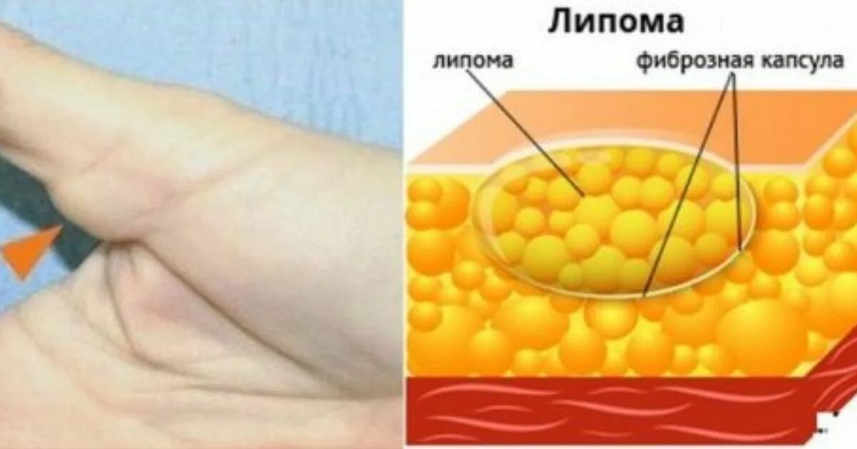 Липома жировой клетчатки. Липома доброкачественная опухоль жировой ткани. Подкожно-жировая клетчатка липома. Липома жировой ткани кожи.