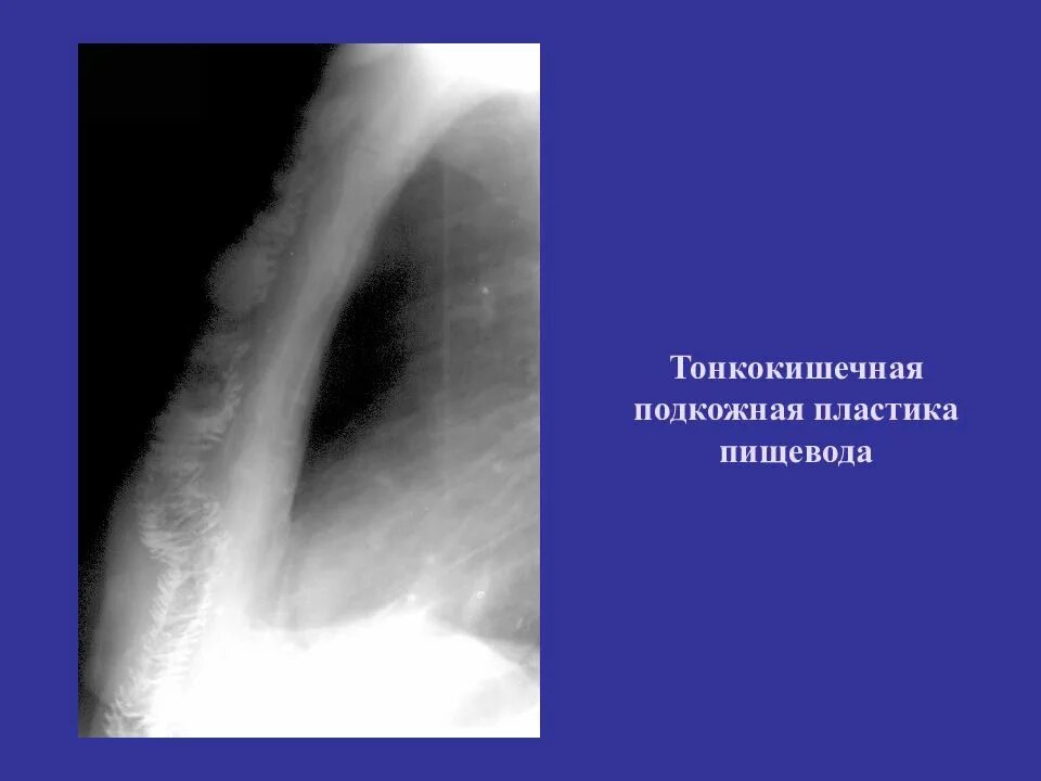 Лучевая пищевода. Тонкокишечная пластика пищевода. Лучевое исследование желудка. Тонкокишечная эзофагопластика. Рентгенология норма и патология пищевода и желудка.