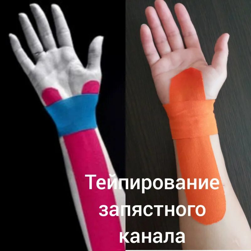 Тейпирование запястья. Тейпирование запястья туннельный синдром. тейпирование запястного сустава. тейпирование кисти руки. тейпирование при синдроме запястного канала.